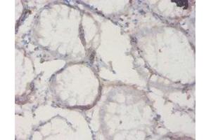 Immunohistochemistry of paraffin-embedded human colon cancer using ABIN7177353 at dilution of 1:20 (IL18BP 抗体  (AA 29-193))