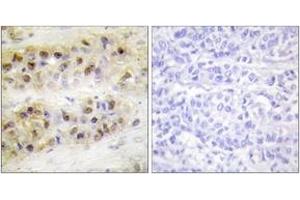 Immunohistochemistry analysis of paraffin-embedded human breast carcinoma tissue, using RORA Antibody.