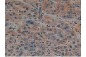 IHC-P analysis of Human Liver Cancer Tissue, with DAB staining. (PLAUR 抗体  (AA 13-114))