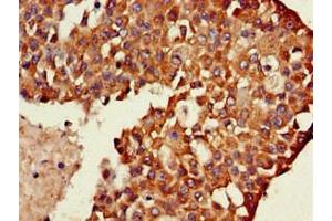 Immunohistochemistry of paraffin-embedded human breast cancer using ABIN7174076 at dilution of 1:100 (TXK 抗体  (AA 32-83))
