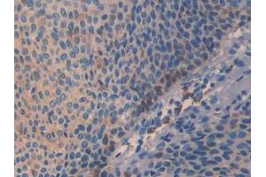 IHC-P analysis of Human Skin cancer Tissue, with DAB staining. (SLIT3 抗体  (AA 1405-1512))