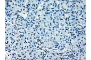 Immunohistochemical staining of paraffin-embedded Adenocarcinoma of colon tissue using anti-NAT8mouse monoclonal antibody. (NAT8 抗体)