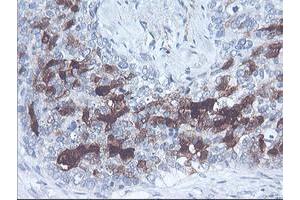 Immunohistochemical staining of paraffin-embedded Adenocarcinoma of Human breast tissue using anti-SERPINB2 mouse monoclonal antibody. (SERPINB2 抗体)