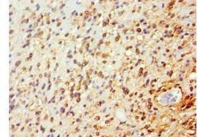 Immunohistochemistry of paraffin-embedded human glioma using ABIN7144651 at dilution of 1:100 (ARNT2 抗体  (AA 440-690))