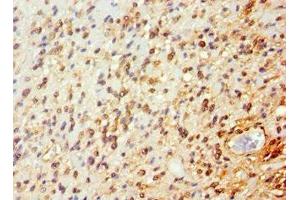 Immunohistochemistry of paraffin-embedded human glioma using ABIN7144651 at dilution of 1:100 (ARNT2 抗体  (AA 440-690))