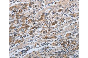 Immunohistochemistry of Human ovarian cancer using SLC34A2 Polyclonal Antibody at dilution of 1:50 (SLC34A2 抗体)