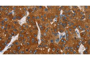 Immunohistochemistry of paraffin-embedded Human liver cancer tissue using CARD9 Polyclonal Antibody at dilution 1:70 (CARD9 抗体)