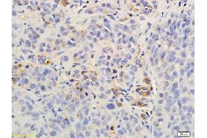 Formalin-fixed and paraffin embedded rat hepatoma labeled with Anti-CXCR2/CD182 Polyclonal Antibody, Unconjugated (ABIN732218) followed by conjugation to the secondary antibody and DAB staining (CXCR2 抗体  (AA 316-360))