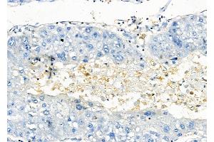ABIN6258088 and ABIN6273896 at 1/100 staining Human liver cancer by IHC-P. (GPR81 抗体  (C-Term))