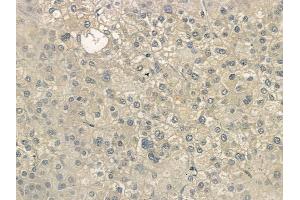 ABIN6264125 and ABIN6272688 at 1/100 staining human hepatocellular carcinoma by IHC-P.
