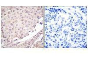 Immunohistochemical analysis of paraffin-embedded human lung carcinoma tissue using Cullin 1 antibody. (Cullin 1 抗体)