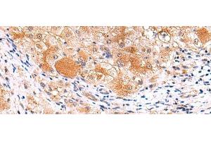 Immunohistochemistry of paraffin-embedded Human liver cancer tissue using ITSN2 Polyclonal Antibody at dilution of 1:40(x200) (Intersectin 2 抗体)