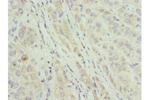 Immunohistochemistry of paraffin-embedded human liver cancer using ABIN7144067 at dilution of 1:100 (CIAPIN1 抗体  (AA 1-312))