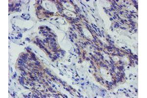 Immunohistochemical staining of paraffin-embedded Carcinoma of Human pancreas tissue using anti-LRRC25 mouse monoclonal antibody.