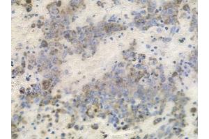 ABIN6256027 and ABIN6267368 at 1/100 staining human melanoma by IHC-P.