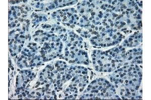 Immunohistochemical staining of paraffin-embedded Adenocarcinoma of breast tissue using anti-CRYAB mouse monoclonal antibody. (CRYAB 抗体)