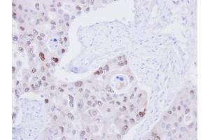 IHC-P Image Immunohistochemical analysis of paraffin-embedded H441 Xenograft, using DNA ligase 3, antibody at 1:100 dilution. (LIG3 抗体  (C-Term))