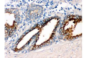 IHC(P): Human Prostatic Cancer Tissue