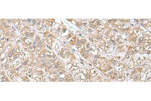 Immunohistochemistry of paraffin-embedded Human liver cancer tissue using EIF1AY Polyclonal Antibody at dilution of 1:55(x200) (EIF1AY 抗体)