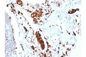 IHC testing of FFPE human lung adenocarcinoma with recombinant Napsin A antibody (clone NAPSA/1865R). (NAPSA 抗体  (AA 189-299))