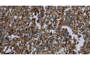 Immunohistochemistry of paraffin-embedded Human liver cancer using GLUL Polyclonal Antibody at dilution of 1:60 (GLUL 抗体)