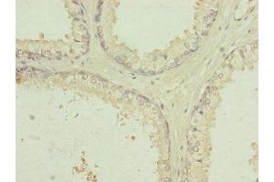 Immunohistochemistry of paraffin-embedded human prostate cancer using ABIN7151092 at dilution of 1:100 (RNF41 抗体  (AA 1-317))