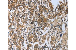 Immunohistochemistry of Human gastic cancer using PRL Polyclonal Antibody at dilution of 1:50 (Prolactin 抗体)