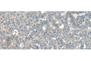 Immunohistochemistry of paraffin-embedded Human liver cancer tissue using UCN3 Polyclonal Antibody at dilution of 1:55(x200) (UCN3 抗体)