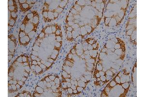 IHC analysis (400X) of CK19 expression in colon cancer, using CK19 antibody (1:1000 dilution). (Cytokeratin 19 抗体  (full length))