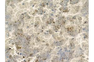 ABIN6260113 and ABIN6272523 at 1/100 staining human melanoma by IHC-P. (ATOH8 抗体  (C-Term))