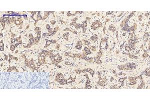 Immunohistochemistry of paraffin-embedded Human liver cancer tissue with Phospho-JAK1 (Tyr1022) Polyclonal Antibody at dilution of 1:200 (JAK1 抗体  (pTyr1022))