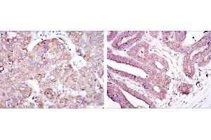 Immunohistochemical analysis of paraffin-embedded liver cancer tissues (left) and stomach cancer tissues (right) using RBP4 mouse mAb with DAB staining. (RBP4 抗体)