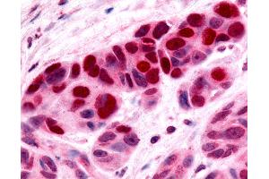 Anti-Nor-1 / NR4A3 antibody IHC of human Skin, Melanoma. (NR4A3 抗体  (C-Term))