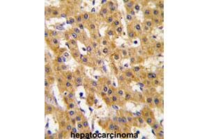Formalin-fixed and paraffin-embedded human hepatocarcinomareacted with PDHX polyclonal antibody , which was peroxidase-conjugated to the secondary antibody, followed by AEC staining. (PDHX 抗体  (Thr11))