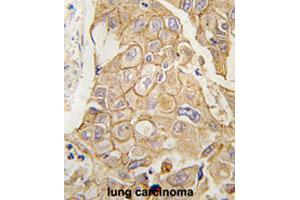 Formalin-fixed and paraffin-embedded human lung carcinomareacted with ADCY2 polyclonal antibody , which was peroxidase-conjugated to the secondary antibody, followed by AEC staining.