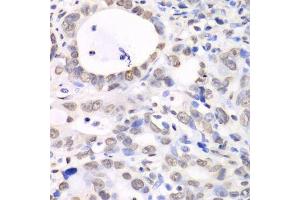 Immunohistochemistry of paraffin-embedded human gastric cancer using Nono Antibody. (NONO 抗体  (AA 1-300))