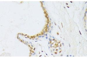 Immunohistochemistry of paraffin-embedded Human breast cancer using ANKRD52 Polyclonal Antibody at dilution of 1:100 (40x lens). (ANKRD52 抗体)