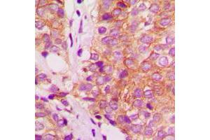 Immunohistochemical analysis of Filamin A staining in human breast cancer formalin fixed paraffin embedded tissue section. (Filamin A 抗体  (C-Term))