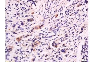 Formalin-fixed and paraffin embedded human colon cancer labeled with Anti-CD53 Polyclonal Antibody, Unconjugated  at 1:200 followed by conjugation to the secondary antibody and DAB staining. (CD53 抗体  (AA 65-160))