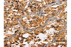 The image on the left is immunohistochemistry of paraffin-embedded Human thyroid cancer tissue using ABIN7190461(DEFA5 Antibody) at dilution 1/15, on the right is treated with synthetic peptide.