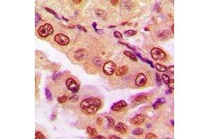 Immunohistochemical analysis of DPF2 staining in human lung cancer formalin fixed paraffin embedded tissue section. (DPF2 抗体)
