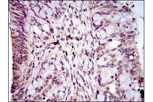 Immunohistochemical analysis of paraffin-embedded rectum cancer tissues using PIWIL4 mouse mAb with DAB staining. (PIWIL4 抗体  (AA 304-434))