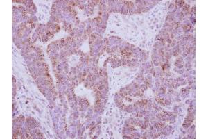 IHC-P Image Immunohistochemical analysis of paraffin-embedded human colon carcinoma, using IL10 Receptor alpha, antibody at 1:250 dilution. (IL-10RA 抗体)