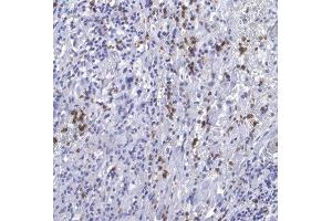 Calprotectin positive cells in tumor stroma. (Calprotectin 抗体)