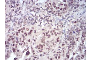 Immunohistochemical analysis of paraffin-embedded human ovarian cancer tissues using SELL mouse mAb with DAB staining.