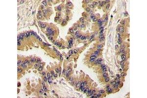 IHC analysis of FFPE human lung carcinoma tissue stained with BMP6 antibody (BMP6 抗体  (AA 25-55))