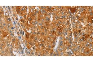 Immunohistochemistry of paraffin-embedded Human liver cancer tissue using ARSG Polyclonal Antibody at dilution 1:30