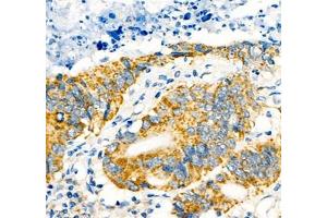 Immunohistochemistry of paraffin embedded human colon cancer using Notch4 (ABIN7074863) at dilution of 1:600 (400x lens) (NOTCH4 抗体)
