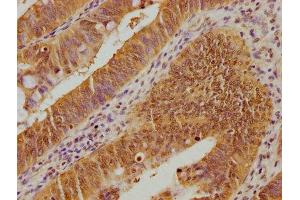 IHC image of ABIN7139932 diluted at 1:100 and staining in paraffin-embedded human colon cancer performed on a Leica BondTM system. (UBE2M 抗体  (AA 11-28))