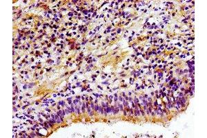 Immunohistochemistry of paraffin-embedded human lung cancer using ABIN7147616 at dilution of 1:100 (Choline Kinase alpha 抗体  (AA 79-173))